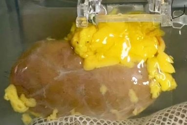 Scientists Develop &#039;Universal Kidney&#039;: Transplanted to any Blood Group