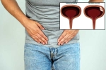 Bladder Cancer treatment, Bladder Cancer reasons, why is bladder cancer common in men, Unhealthy eating habits