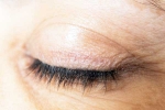 Eyelash Dandruff new breaking, Eyelash Dandruff medication, all about eyelash dandruff, Inflammatory diseases